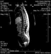 Spinal cord CAT scan 1