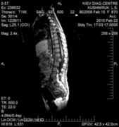 Spinal cord CAT scan 2